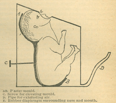 Infant resuscitator by Dr. Egon Braun.